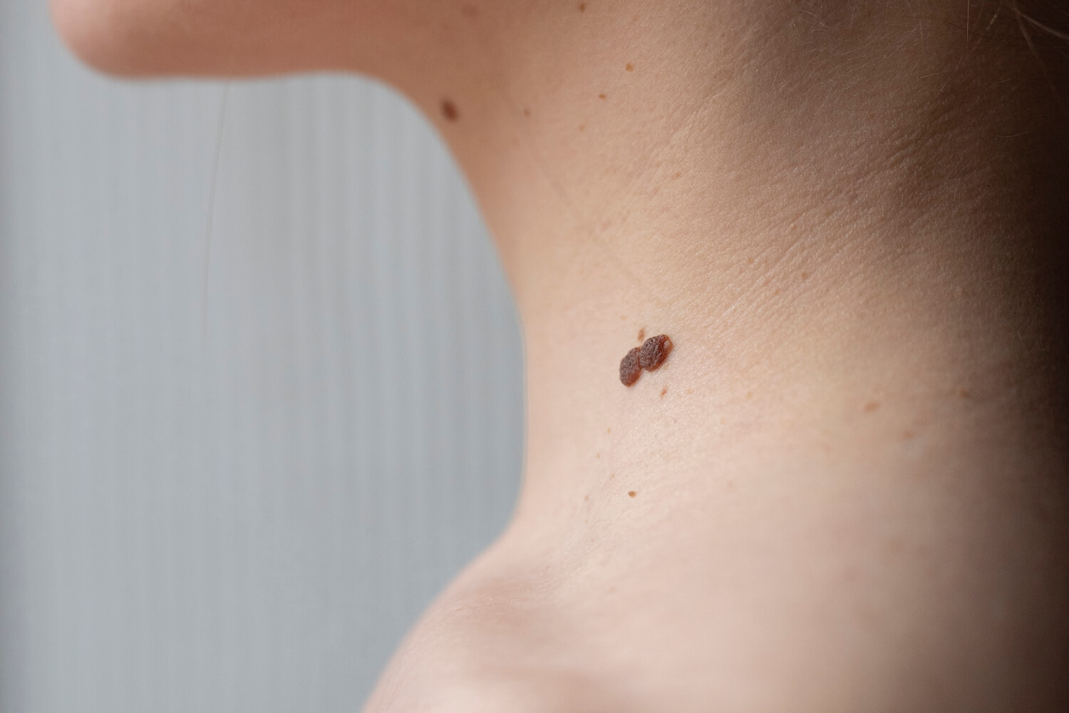 Skin Tags